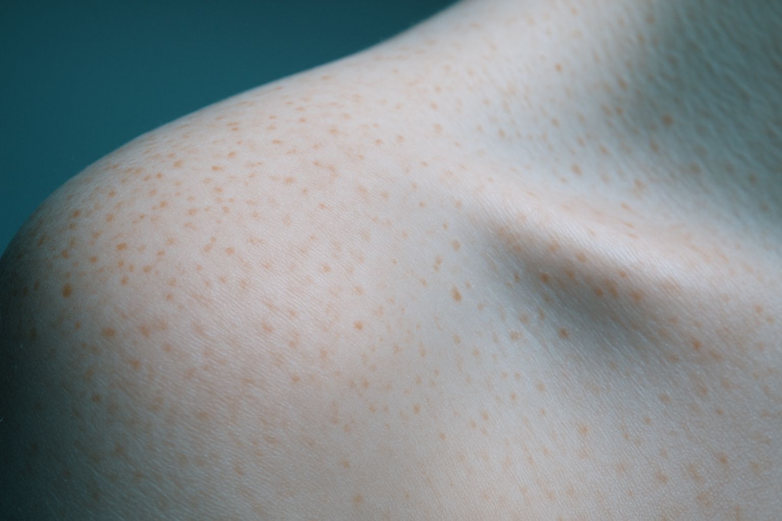 Pigmentation and Melasma Treatment in London, editorial image
